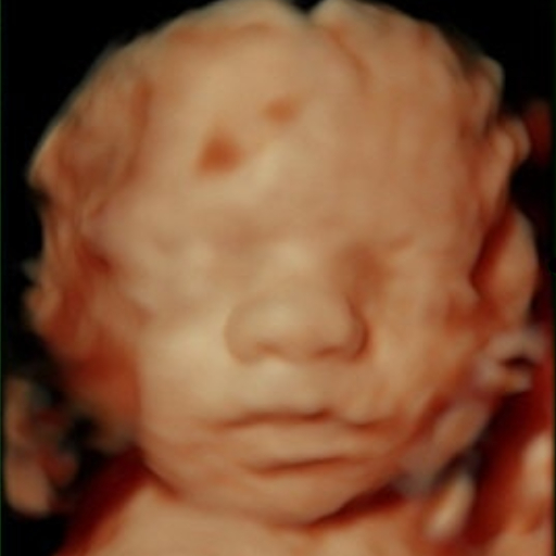 3D prenatal ultrasound before 8K AI improvement