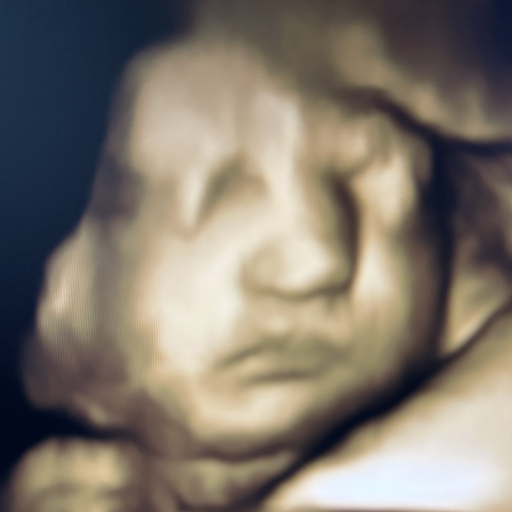 Original prenatal ultrasound scan before AI processing